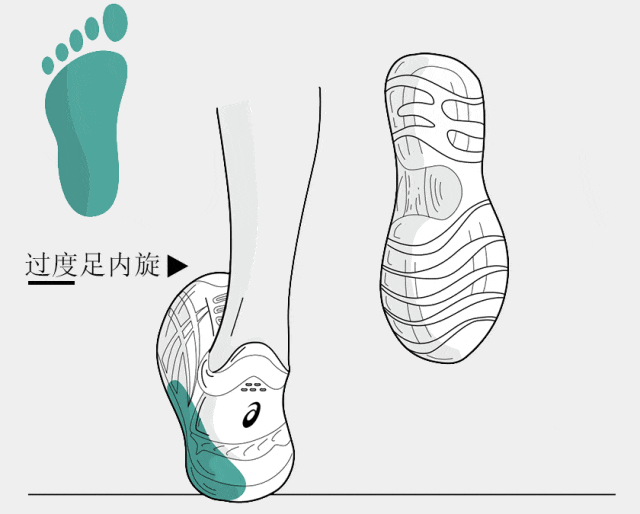 过度内旋
